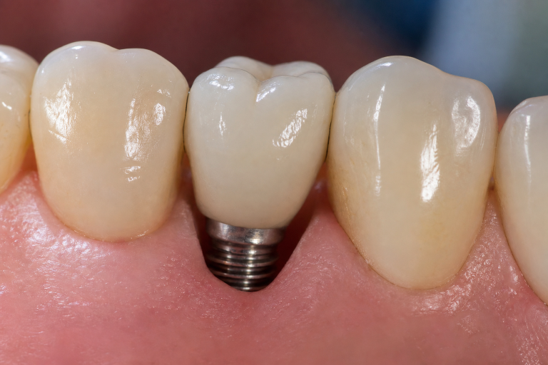 Choosing A Tooth Replacement Plan: A Practical Guide To Comfort, Care, And Daily Function