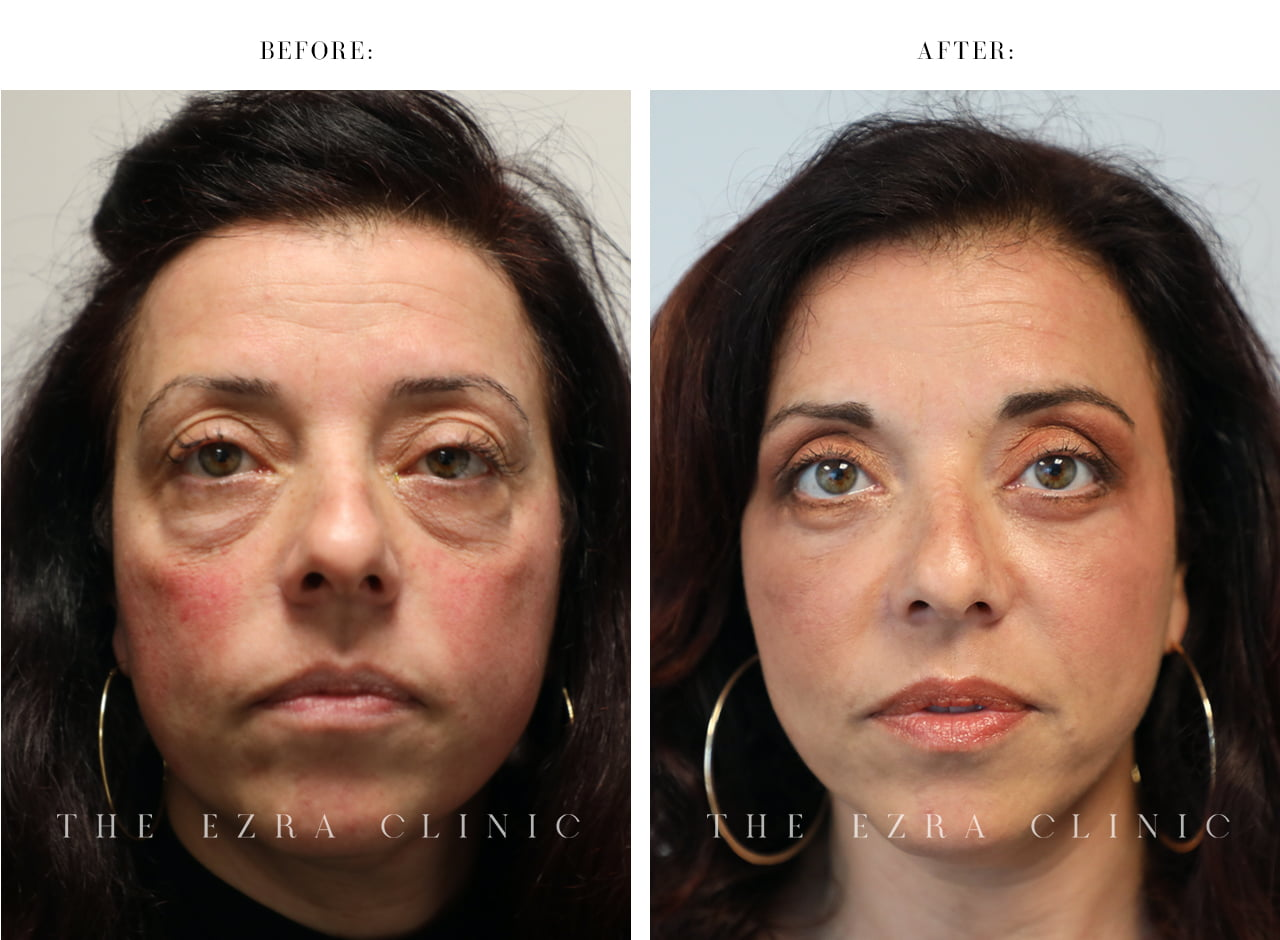 upper blepharoplasty before and after
