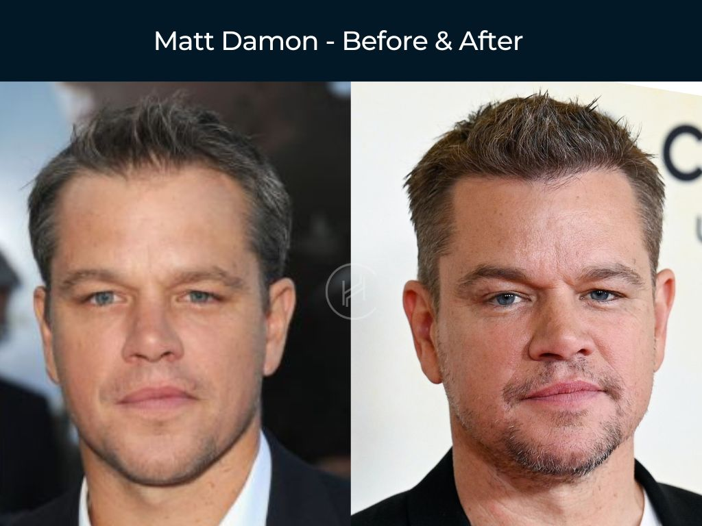 hair transplant famous actors