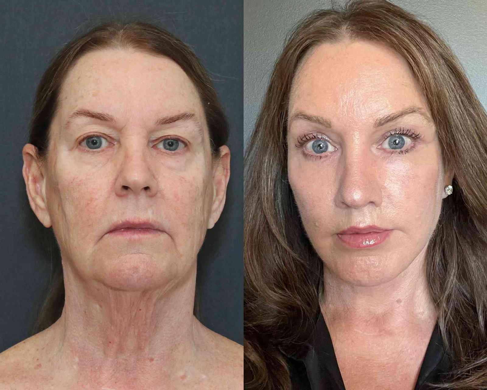 Facelift Before and After: What to Expect From the Transformation